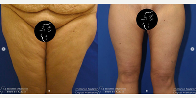 45-54 year old woman treated with Thigh Lift - This 48 year old female patient initially weighed 260 pounds. The patient had gastric bypass surgery, lost 100 pounds, and was not happy with the excess skin and fat in their thighs. So, Dr. Katzen performed a medial thigh lift.