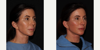 45-54 year old woman treated with Facelift - 1 month post op