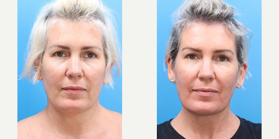 47 year old woman treated with FaceTite, Nonsurgical Neck Lift - This 47-year-old patient was treated with MyEllevate with FaceTite