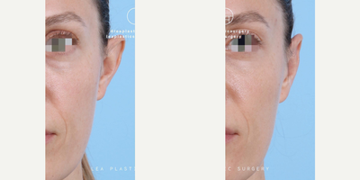 Woman treated with Ear Surgery - Woman treated with Ear Surgery