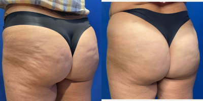 55-64 year old woman treated with Qwo - 55 year old female shown 6 weeks after her 3rd treatment with QWO to treat buttock cellulite/dimples.
