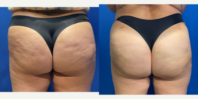 55-64 year old woman treated with Qwo - 55 year old female shown 6 weeks after her 3rd treatment with QWO to treat buttock cellulite/dimples.