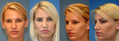 rhinoplasty - 
	Nasal hump and tip work, open rhinoplasty

