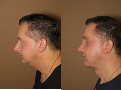 35-44 year old man treated with Rhinoplasty - rhinoplasty, mini neck lift and chin augmentation