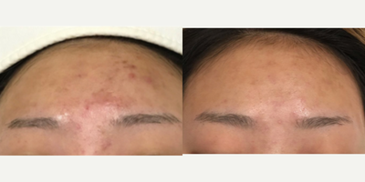 25-34 year old woman treated with PicoSure - 25-34 year old woman treated with PicoSure, 3 Sessions.