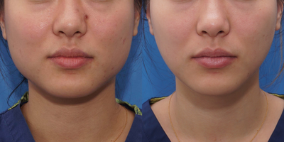 18-24 year old woman treated with Morpheus8 - 24 year old treated with Botox in masseter muscle and Morpheus8 for cheek and jawline tightening, and microneedling for acne scarring