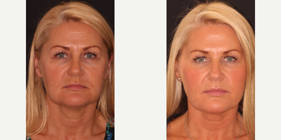 45-54 year old woman treated with Silhouette Soft - Silhouette Soft suture lift for jawline, jowls and mid face (see photos before and 6 weeks post treatment)