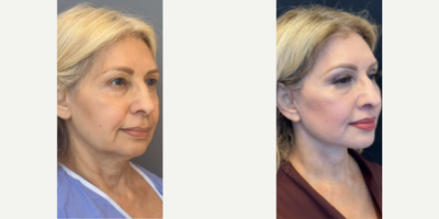 Woman treated with Facial Fat Transfer - Woman treated with Deep Plane Facelift, Neck Lift, Brow Lift, Lip Lift, and Facial Fat Transfer