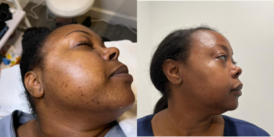 35-44 year old woman treated with VI Peel - Before and After Photos of our physician who underwent the VI Peel for hyperpigmentation and acne. This peel is PAINLESS and is safe for all skin tones. Look at the dramatic improvement following 7 days of the application. The VI peel is used to treat sun damage, acne, acne scarring, rosacea, fine lines and wrinkles, melasma, and improve skin tone and texture. It can be combined with botox on the same day for an even greater result.