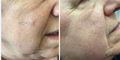65-74 year old man treated with Cyst Removal - 74 year old man getting a cyst removed from the cheek.