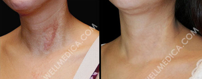 25-34 year old woman treated with Vbeam - The Candela Vbeam produces an intense, but gentle, burst of light that selectively destroys the blood vessels of your spider veins, without damaging the surrounding tissue. After laser treatment the surrounding tissue is left intact. The Vbeam can also treat rosacea, leg veins, scars, warts, stretch marks, hemangiomas, and red birthmarks. It does so quickly and conveniently with virtually no pain.