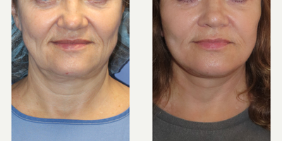 55-64 year old woman treated with Facelift Revision and Facial Fat Transfer - 3 weeks post-surgery - Only 3 weeks post-op! The patients swelling will continue to subside.