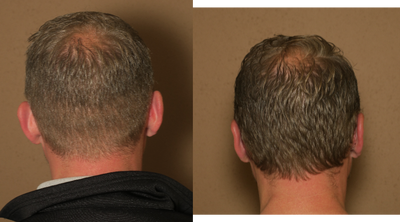 35-44 year old man treated with Ear Surgery - otoplasty