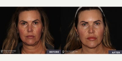 Woman treated with Skin Tightening, Skin Rejuvenation - Pictured: before and after of Emface treatment