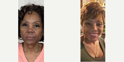 65-74 year old woman treated with Lip Lift, Lip Surgery, Lip Repositioning - Lip lift performed in combination with deep plane facelift and neck lift surgery to restore facial harmony and create elegant, natural rejuvenation. Notice the improvement in facial balance, horizontal thirds, upper tooth show, and the meticulously concealed lip lift scar. Smiling views also demonstrate preservation of natural facial expression and harmony following facial rejuvenation surgery.