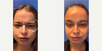 Woman treated with Dysport - Woman treated with Dysport to crows feet, forehead, and glabellar lines, shown 3 days post op.