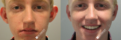 Man treated with Ear Surgery - Underwent bilateral Otoplasty and his post-operative photos demonstrate his appearance a mere four days following surgery.