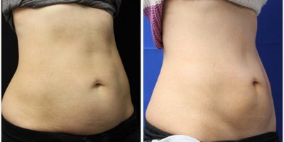 35-44 year old woman treated with CoolSculpting Elite - 35-44 year old woman treated with CoolSculpting Elite
