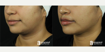 25-34 year old woman treated with AccuTite, Lip Lift - This patient underwent a combination of Accutite to reduce the fullness of her jowls and double chin area, as well as a lip lift to evert and shape the upper lip. After photo is 2 months post-operation.