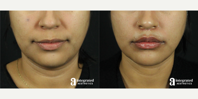 25-34 year old woman treated with AccuTite, Lip Lift - This patient underwent a combination of Accutite to reduce the fullness of her jowls and double chin area, as well as a lip lift to evert and shape the upper lip. After photo is 2 months post-operation.