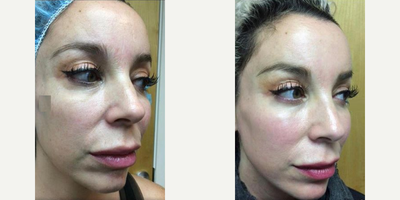 Woman treated with Fraxel Laser - Woman treated with Fraxel Laser