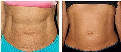 Thermage for tummy - Thermage radio frequency tightens and lifts skin on the abdomen.