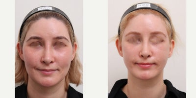 25-34 year old woman treated with Nonsurgical Facelift, AccuLift, Liposuction - Chief Complain: uneven face lines, hollowed under eyes, chubby cheeks, squared face shapeTreatment Plan: facial fat graft, under eye fat reposition, face liposuction ( cheeks, double chine, zygomatic angle) Outcome: - smooth V-lined face line - younger and refreshed look