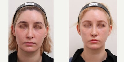 25-34 year old woman treated with Nonsurgical Facelift, AccuLift, Liposuction - Chief Complain: uneven face lines, hollowed under eyes, chubby cheeks, squared face shapeTreatment Plan: facial fat graft, under eye fat reposition, face liposuction ( cheeks, double chine, zygomatic angle) Outcome: - smooth V-lined face line - younger and refreshed look