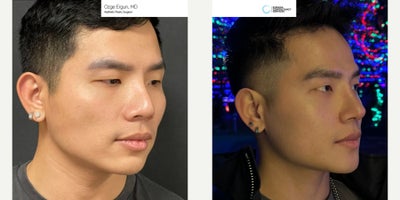 25-34 year old man treated with Chin Implant, Jaw Implants, Rhinoplasty - Chin & Jaw Implant, Rhinoplasty Surgery