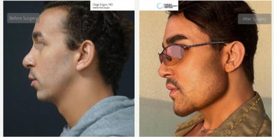 25-34 year old man treated with Chin Implant, Jaw Implants - Chin & Jaw Implant Surgery
