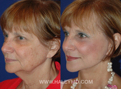 65-74 year old woman treated with Neck Lift - Face and neck lift performed in the office under local anesthesia with oral sedation.