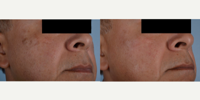 55-64 year old man treated with Chemical Peel - PCA Chemical Peel with Obagi Clear
