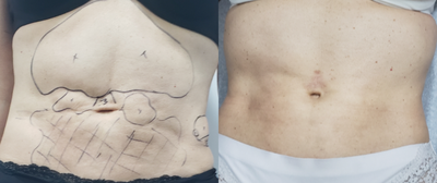 45-54 year old woman treated with Liposuction Revision - the patient has had 5 Revision surgeries elsewhere but none of her problems were getting better. every revision surgery made things worse for her. this is a hard case of extreme fibrosis and it was very difficult to treat as she has minimal fat that could be used for grafting. I was able to use my technique of Mini-SIF and scar release to release all the fibrotic scarring and to improve the defects. I also did small umbilical reconstructive surgery to fix the umbilical droop.