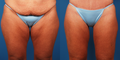 40 - 50 Year Old Female - 
	Surgical Procedure: Abdominoplasty with hip plasty and liposuction of the medial and lateral thighs. This patient desired correction of abdomen and thighs after losing 90 pounds through diet and exercise.
