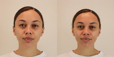 25-34 year old woman treated with Microdermabrasion - Microdermabrasion treatment on 26 year old woman