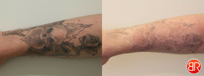 Tattoo Removal - Before & After 1 treatment of Tattoo Removal. Combining Fractionated Laser & Q-Switch.