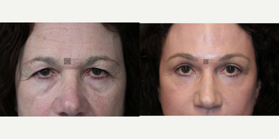 Fractora RF - Fractora RF