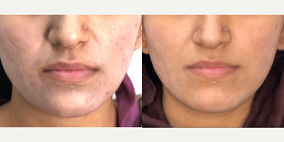 18-24 year old woman treated with Vampire Facial - Vampire Facial with PRP