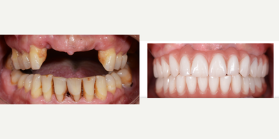 45-54 year old woman treated with Dental Bone Graft - Root Canal with Fiber Post, All-on-6 Dental Implants, Dental Bone Graft and Smile Makeover with Zirconium Dental Crowns.