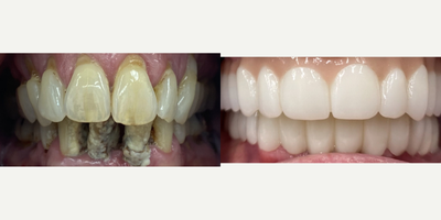 55-64 year old woman treated with Smile Makeover, Mini Dental Implants - Treatment: Full Mouth Restoration - Upper Roundhouse (URH) + Lower Roundhouse (LRH)Purpose: Improve functionality, aesthetics, and overall comfort.Process: Consultation, decide on treatment, load implants, put on a temporary, and finalize. In the 'after' picture, the patient has a temporary upper roundhouse and the bottom is the final cemented zirconia bridge. Once the top is all healed up, we will cement the final upper roundhouse.Results: Beautiful, non-removable cemented URH + LRH made out of Zirconia. Healing times and procedures will vary from patient to patient. Looking forward to making you smile again