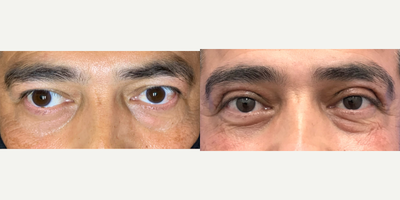 45-54 year old man treated with Eyelid Surgery - Heavy eyelids on this patient were treated with blepharoplasty surgery, resulting in no vision obstruction from the upper eyelids and a more youthful, awake appearance.