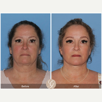 45-54 year old woman treated with Deep Plane Facelift, Neck Lift, Brow Lift, CO2 Laser, MACS Facelift - 52 year old treated with Deep Plane Face and Neck Lift, Temporal Brow Lift, CO2 Laser of Face, MAC