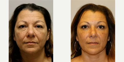 Woman treated with Facial Fat Transfer - Woman treated with Facial Fat Transfer from abdomen as well as Upper and Lower Blepharoplasty. Pre-op, she felt her eyes looked heavy and her friends felt that she hadn't gotten sleep.