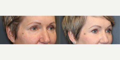 Stem cell rich fat transfer and laser. - Fat transfer to upper eyelids and face with laser treatment and scar treatment.