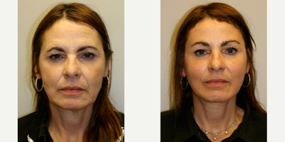 Woman treated with SMAS Facelift - This woman who came to our palo alto plastic surgery office desiring a fresher look. She felt she looked tired and friends and coworkers always asked if she was upset or tired. She opted for a High- SMAS facelift with brow lift and laser resurfacing.This created a rejuvenated look to the face elevating the deeper facial muscles in a vertical direction for a long lasting and natural appearance.