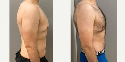 25-34 year old man treated with Gynecomastia Surgery, Male Tummy Tuck - 33 yo male s/p gynecomastia and male tummy tuck performed in our on site AAAA certified operating suite.