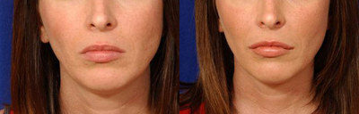 Before and After Lip Augmentation - Before and After Lip Augmentation
