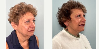 65-74 year old woman treated with Facelift, Eyelid Surgery - Patient who underwent upper and lower blepharoplasty with facelift.