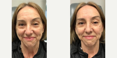 Woman treated with Dysport - Woman treated with Dysport to crows feet as well as Dermal Fillers to cheeks, shown immediately after the treatment.