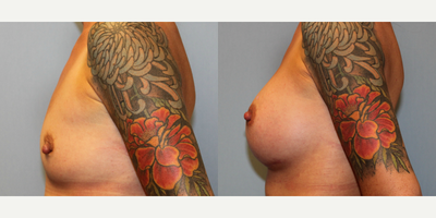 25-34 year old woman treated with Breast Augmentation - This patient in her early-thirties was looking to increase the volume in her breasts. She desired a natural appearance with slight augmented upper fullness. She opted for submuscular Allergan Inspira implants at 405cc. This is her results at 12 weeks.